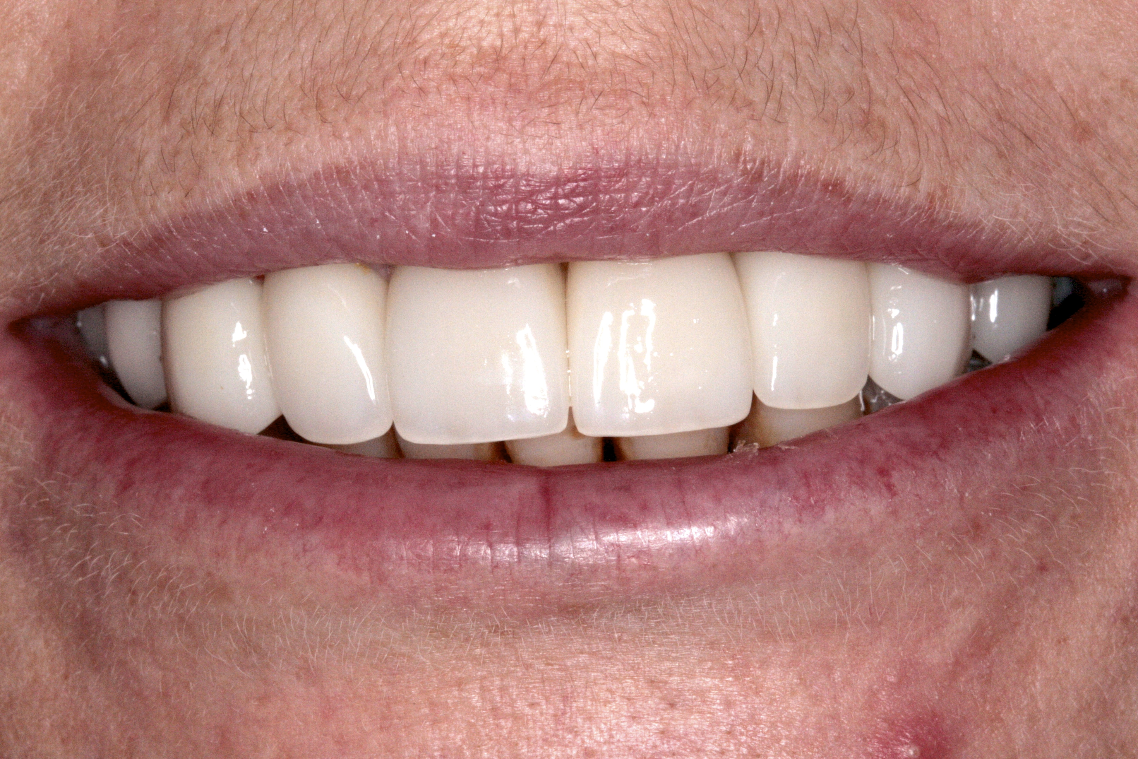 Case Study Porcelain Veneers & Implants MSG Dental Practice
