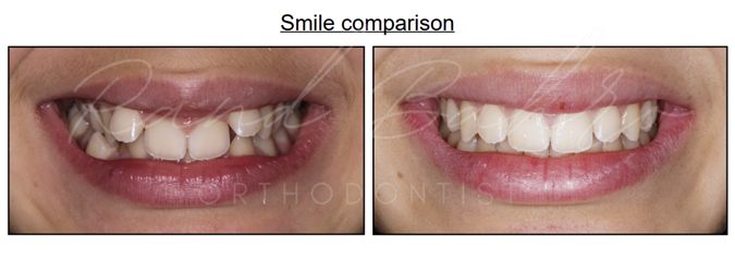 Orthodontic treatment results on 12 year old girl